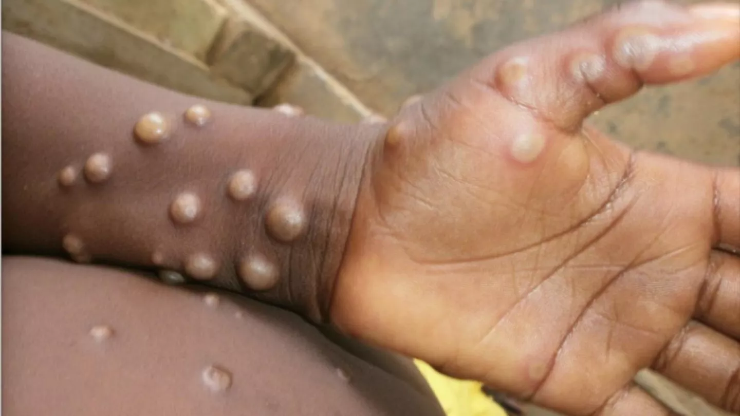 Côte d&rsquo;Ivoire : Six cas de variole du singe confirmés, une surveillance renforcée s&rsquo;impose